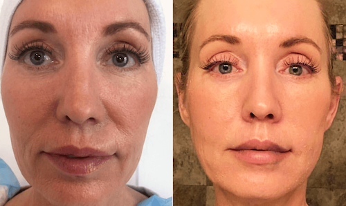 plasma facial rejuvenation before after mississauga oakville